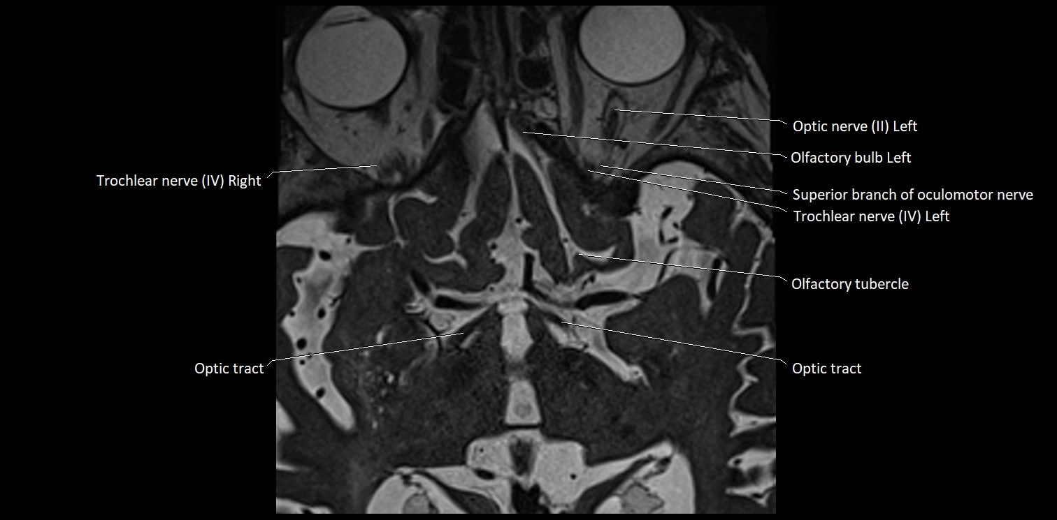 Cranial nerve anatomy axial MRI 3T image 6.webp